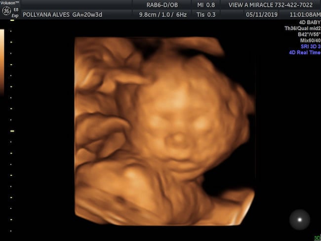 Hình ảnh siêu âm 4D khuôn mặt em bé 20 tuần tuổi