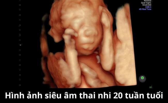 Hình ảnh siêu âm thai nhi 20 tuần