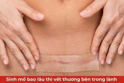 sinh mổ bao lâu thì vết thương bên trong lành thumb