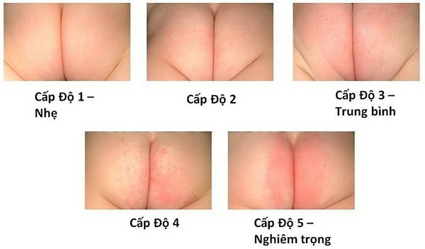 Phù hợp với tình trạng làn da của bé