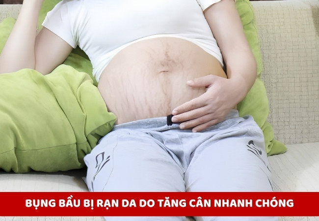 Hình ảnh bụng bầu bị rạn