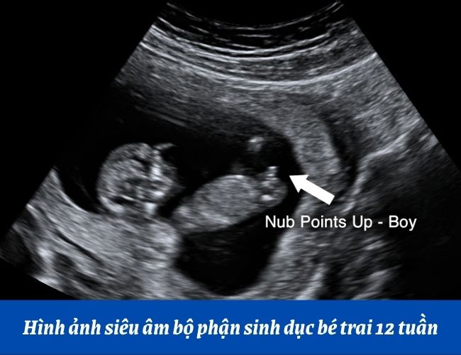 hình ảnh siêu âm biết giới tính thai nhi