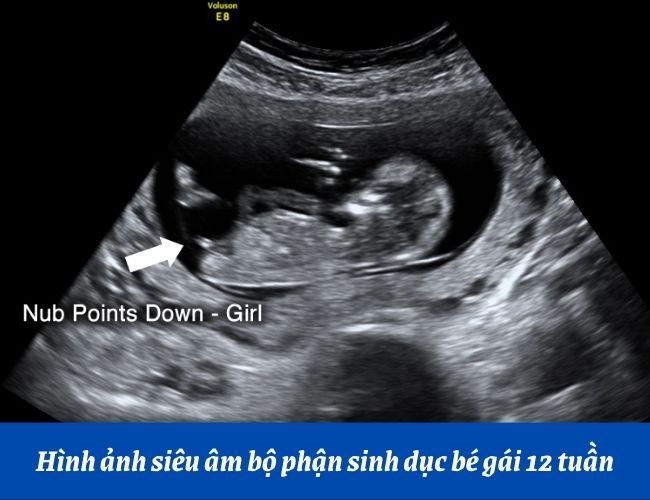 siêu âm thai nhi giới tính nữ