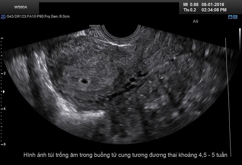 hình ảnh siêu âm thai 5 tuần