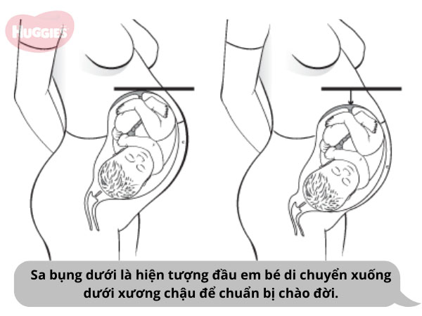 sa bụng dưới chuyển dạ