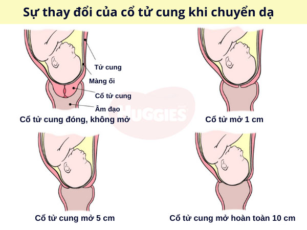 cổ tử cung giãn báo hiệu sắp sinh